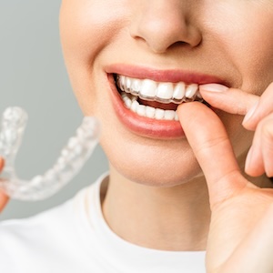 Invisalign